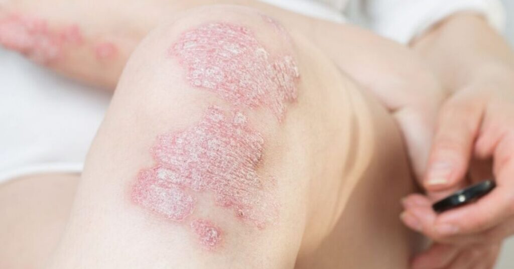 Autoimmune disorder causing inflammation and immune system attack