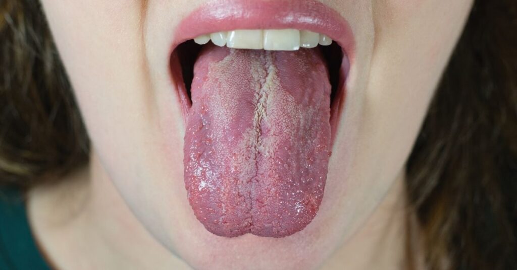 Candida yeast infection affecting the body and digestive system